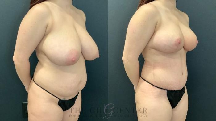 Mommy Makeover Case 500 Before & After Right Oblique | The Woodlands, TX | The Gill Center for Plastic Surgery and Dermatology