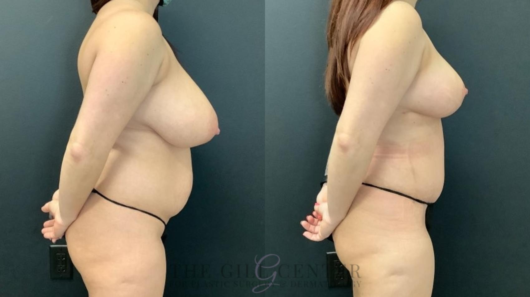 Mommy Makeover Case 500 Before & After Right Side | The Woodlands, TX | The Gill Center for Plastic Surgery and Dermatology