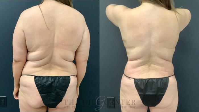 Mommy Makeover Case 508 Before & After Back | The Woodlands, TX | The Gill Center for Plastic Surgery and Dermatology