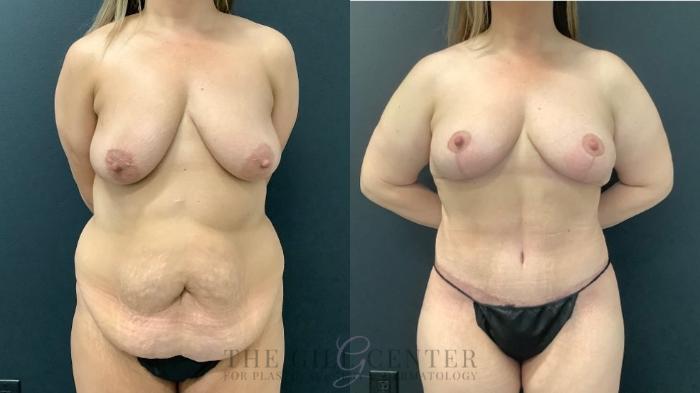 Mommy Makeover Case 508 Before & After Front | The Woodlands, TX | The Gill Center for Plastic Surgery and Dermatology