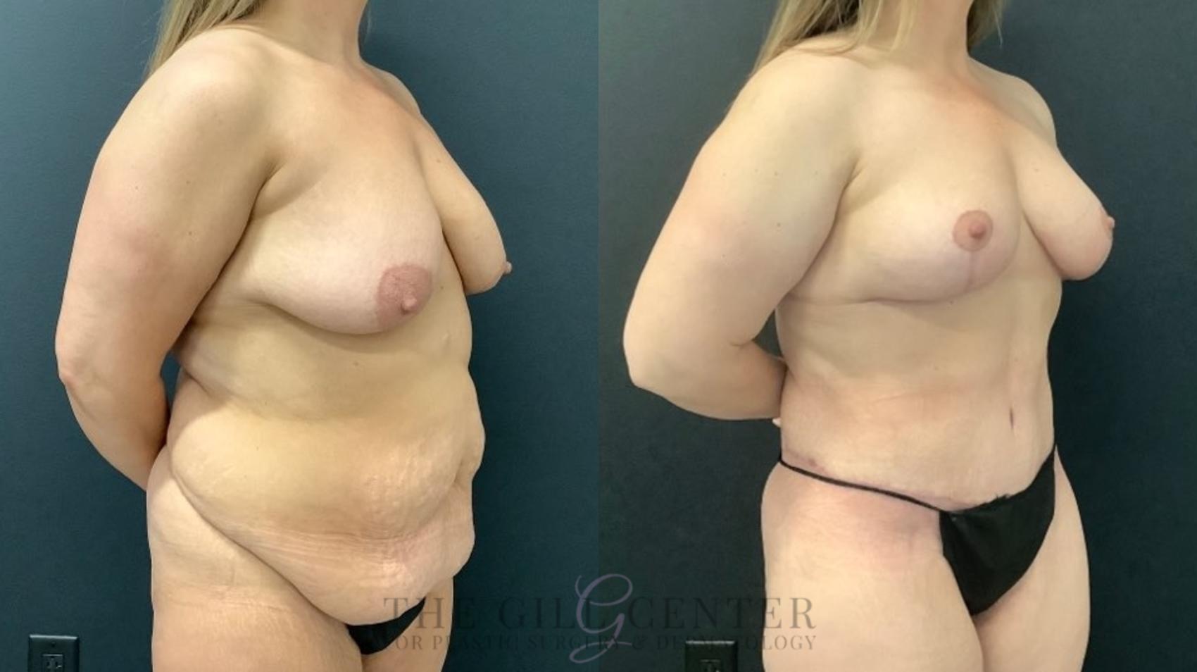 Mommy Makeover Case 508 Before & After Right Oblique | The Woodlands, TX | The Gill Center for Plastic Surgery and Dermatology