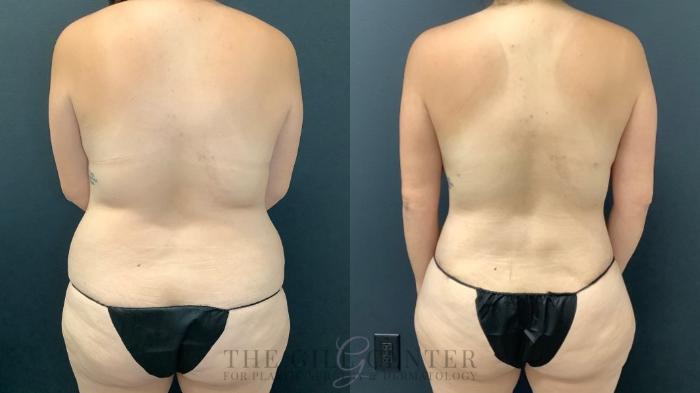 Mommy Makeover Case 513 Before & After Back | The Woodlands, TX | The Gill Center for Plastic Surgery and Dermatology