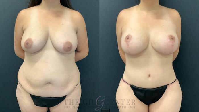 Mommy Makeover Case 513 Before & After Front | The Woodlands, TX | The Gill Center for Plastic Surgery and Dermatology