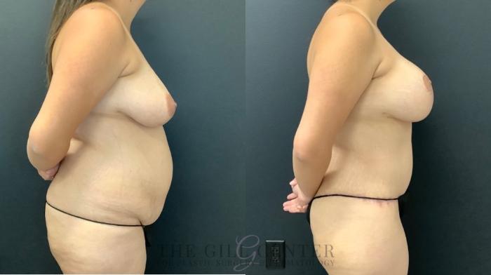Mommy Makeover Case 513 Before & After Right Side | The Woodlands, TX | The Gill Center for Plastic Surgery and Dermatology