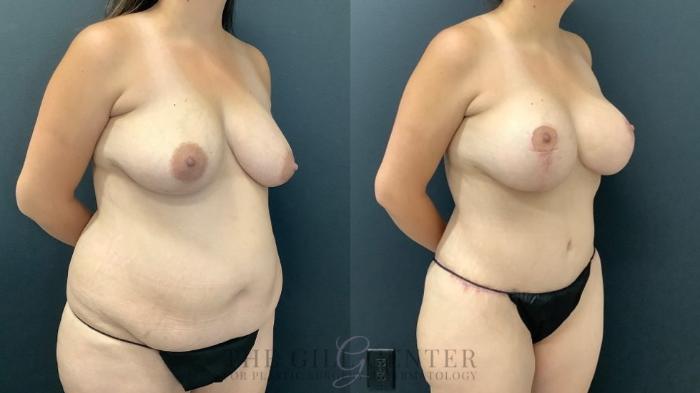 Mommy Makeover Case 513 Before & After Right Three-quarter view | The Woodlands, TX | The Gill Center for Plastic Surgery and Dermatology