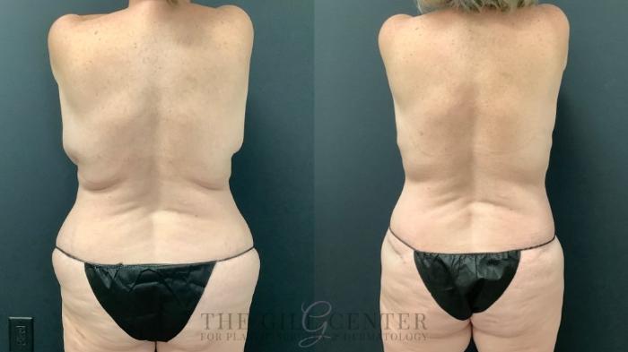 Mommy Makeover Case 522 Before & After Back | The Woodlands, TX | The Gill Center for Plastic Surgery and Dermatology