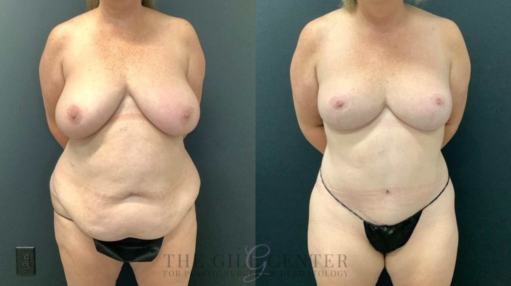 Mommy Makeover Case 522 Before & After Front | The Woodlands, TX | The Gill Center for Plastic Surgery and Dermatology