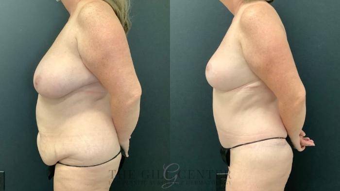 Mommy Makeover Case 522 Before & After Left Side | The Woodlands, TX | The Gill Center for Plastic Surgery and Dermatology