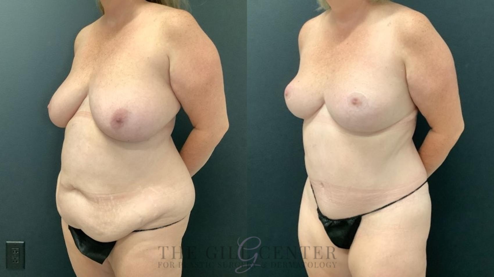 Mommy Makeover Case 522 Before & After Left Three-quarter view | The Woodlands, TX | The Gill Center for Plastic Surgery and Dermatology