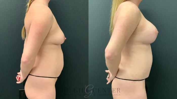 Mommy Makeover Case 528 Before & After Right Side | The Woodlands, TX | The Gill Center for Plastic Surgery and Dermatology