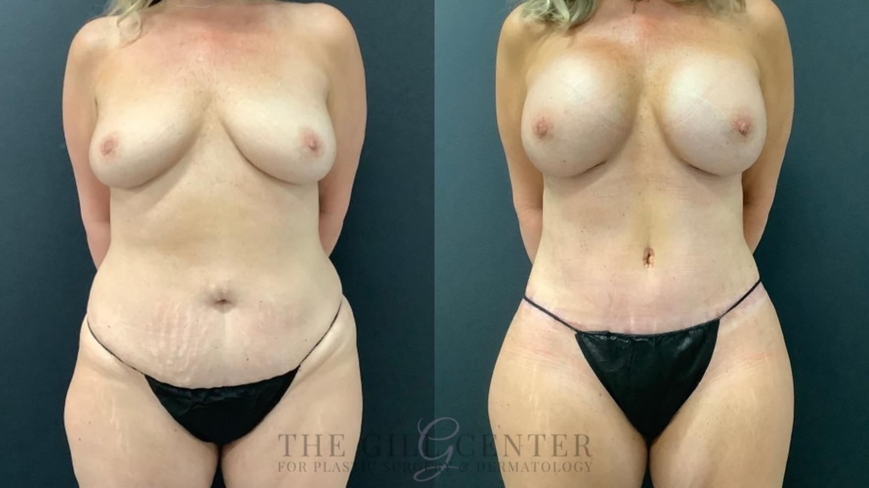 Mommy Makeover Case 530 Before & After Front | The Woodlands, TX | The Gill Center for Plastic Surgery and Dermatology