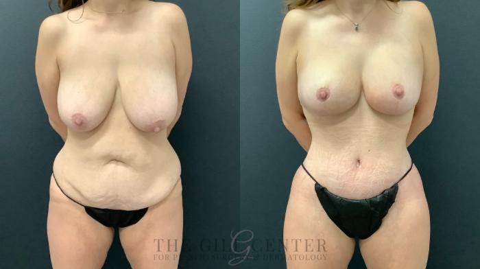 Mommy Makeover Case 532 Before & After Front | The Woodlands, TX | The Gill Center for Plastic Surgery and Dermatology