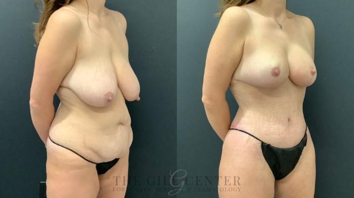 Mommy Makeover Case 532 Before & After Right Oblique | The Woodlands, TX | The Gill Center for Plastic Surgery and Dermatology