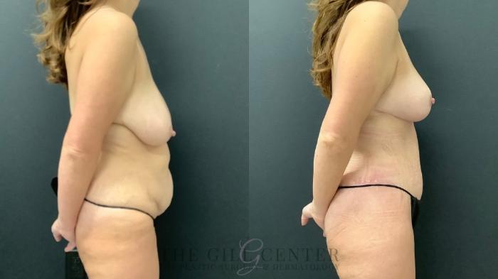 Mommy Makeover Case 532 Before & After Right Side | The Woodlands, TX | The Gill Center for Plastic Surgery and Dermatology