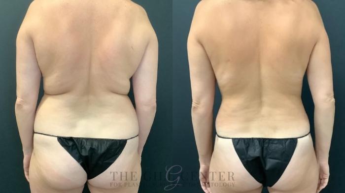 Mommy Makeover Case 539 Before & After Back | The Woodlands, TX | The Gill Center for Plastic Surgery and Dermatology