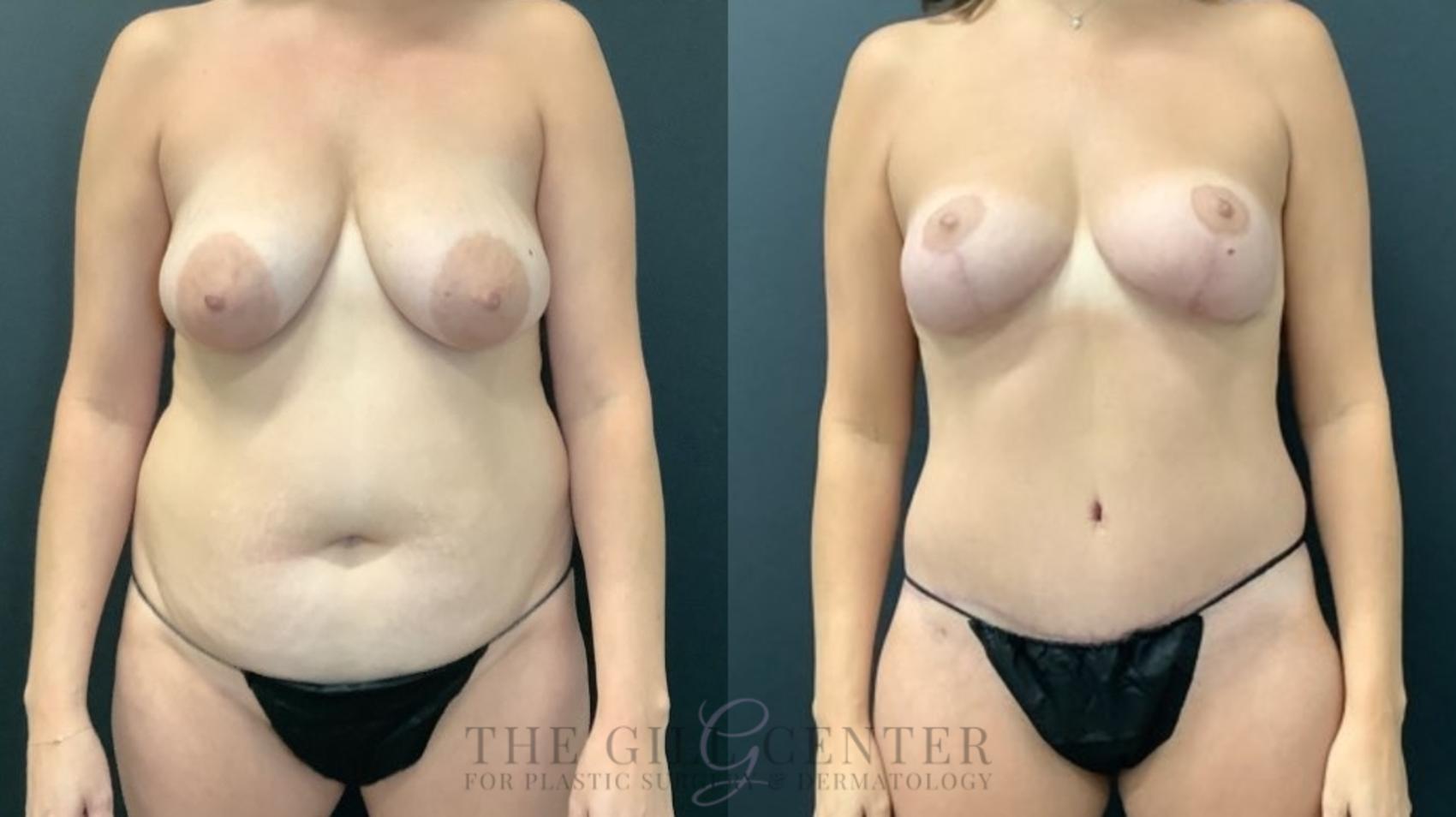 Mommy Makeover Case 539 Before & After Front | The Woodlands, TX | The Gill Center for Plastic Surgery and Dermatology