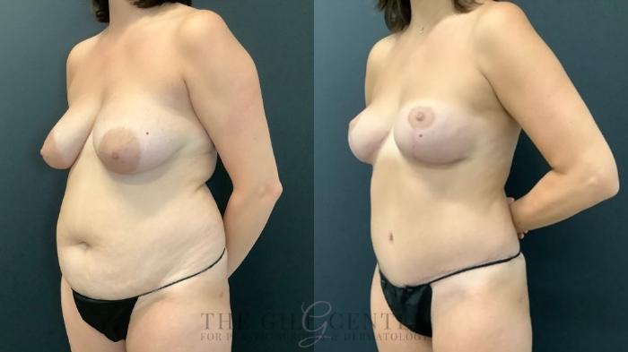 Mommy Makeover Case 539 Before & After Left Oblique | The Woodlands, TX | The Gill Center for Plastic Surgery and Dermatology