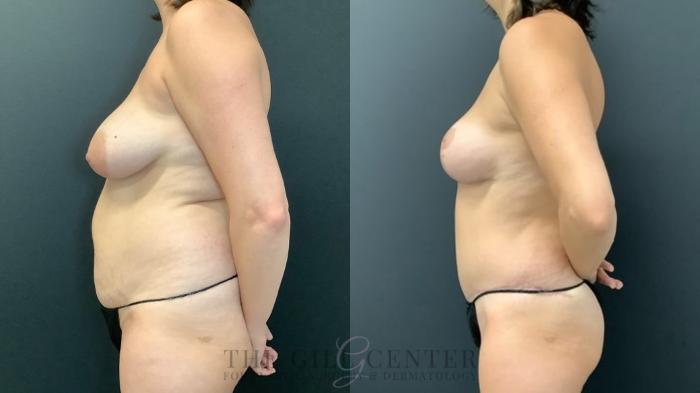 Mommy Makeover Case 539 Before & After Left Side | The Woodlands, TX | The Gill Center for Plastic Surgery and Dermatology