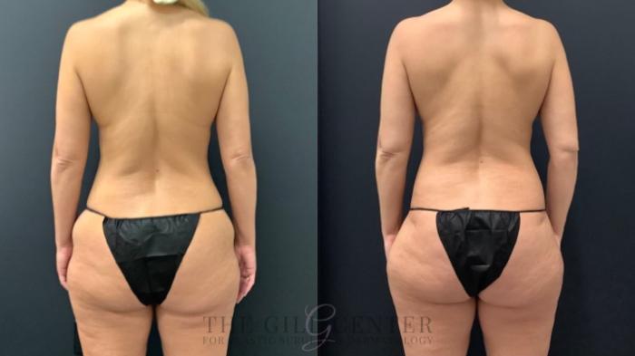 Mommy Makeover Case 542 Before & After Back | The Woodlands, TX | The Gill Center for Plastic Surgery and Dermatology