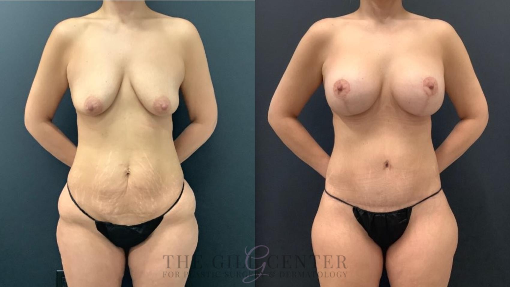 Mommy Makeover Case 542 Before & After Front | The Woodlands, TX | The Gill Center for Plastic Surgery and Dermatology
