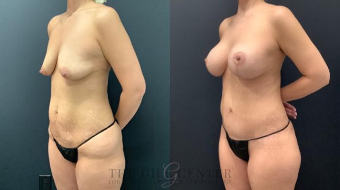 Mommy Makeover Case 542 Before & After Left Oblique | The Woodlands, TX | The Gill Center for Plastic Surgery and Dermatology