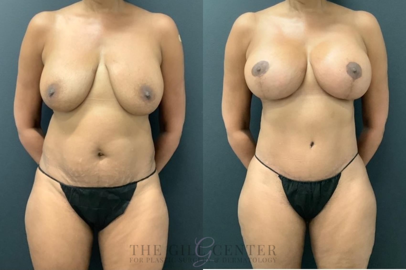 Mommy Makeover Case 543 Before & After Front | The Woodlands, TX | The Gill Center for Plastic Surgery and Dermatology