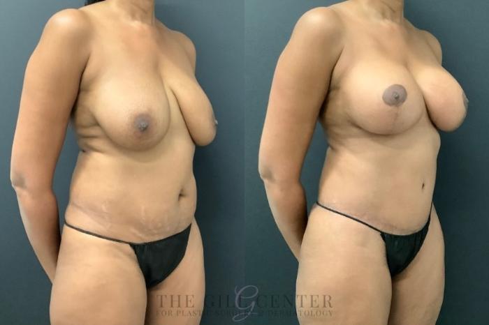 Mommy Makeover Case 543 Before & After Right Oblique | The Woodlands, TX | The Gill Center for Plastic Surgery and Dermatology
