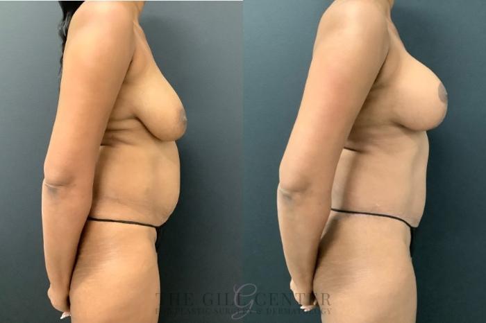 Mommy Makeover Case 543 Before & After Right Side | The Woodlands, TX | The Gill Center for Plastic Surgery and Dermatology