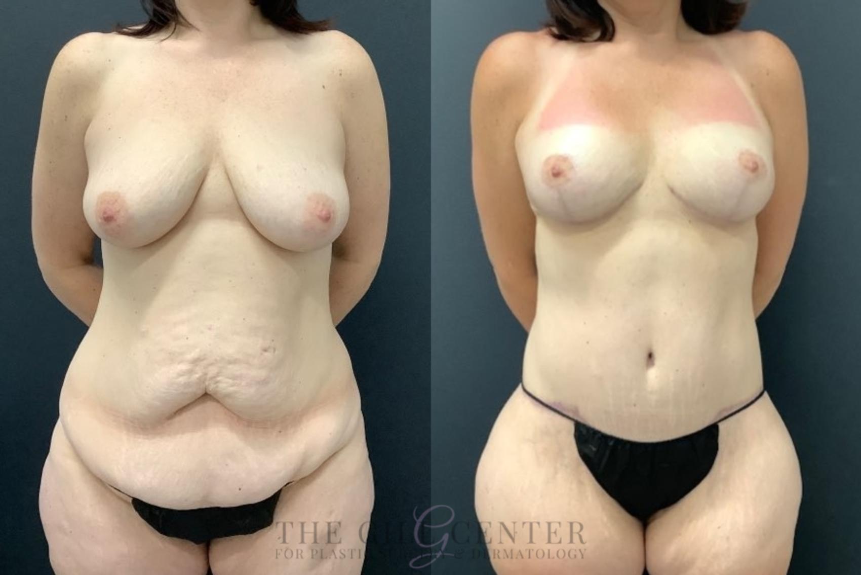 Mommy Makeover Case 545 Before & After Front | The Woodlands, TX | The Gill Center for Plastic Surgery and Dermatology
