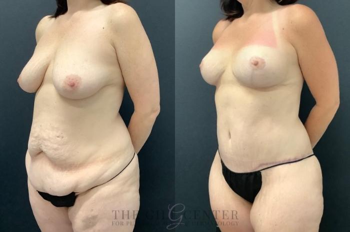 Mommy Makeover Case 545 Before & After Left Oblique | The Woodlands, TX | The Gill Center for Plastic Surgery and Dermatology