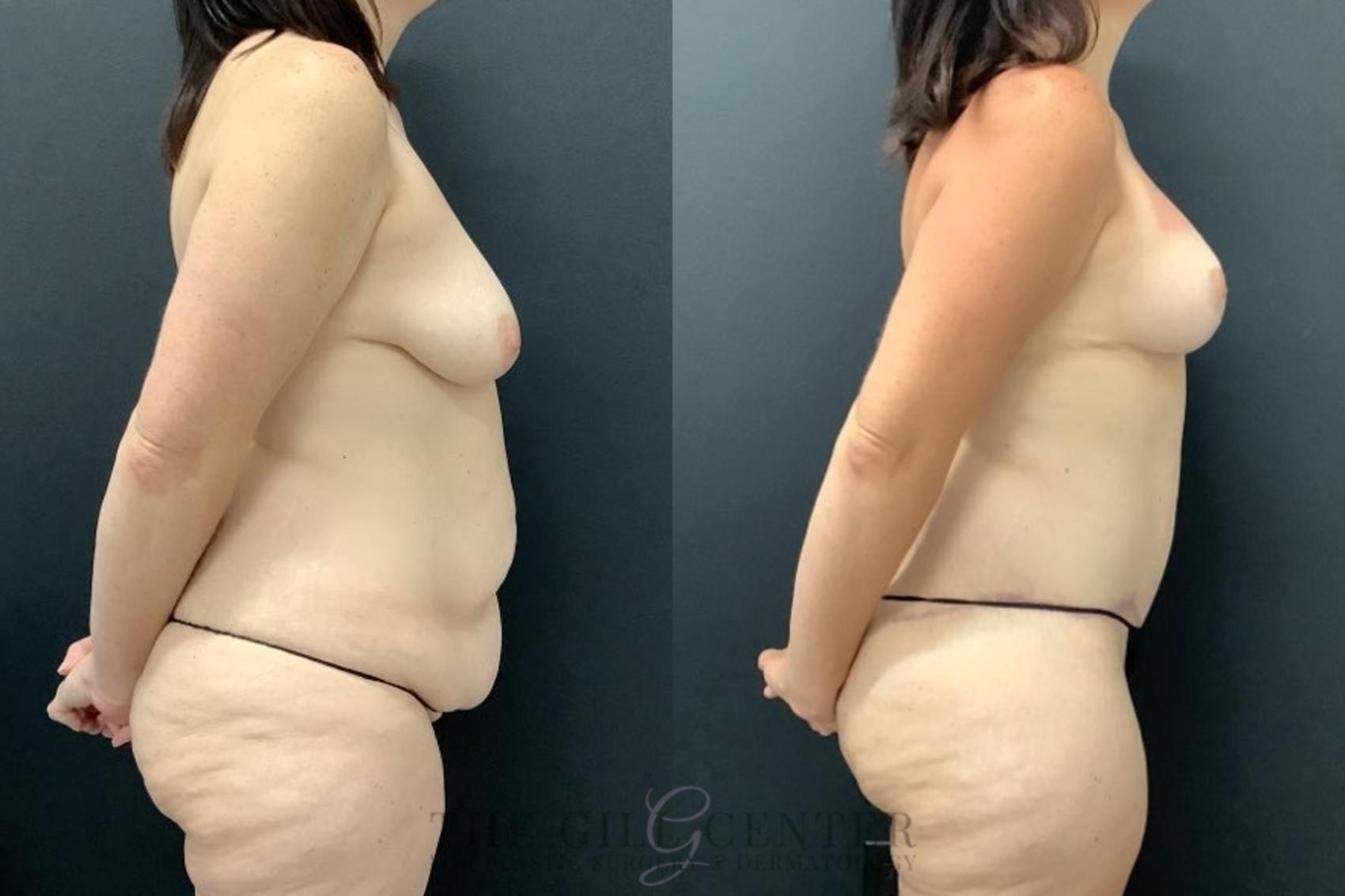 Mommy Makeover Case 545 Before & After Right Side | The Woodlands, TX | The Gill Center for Plastic Surgery and Dermatology