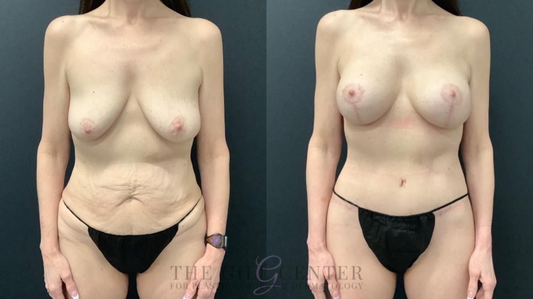 Mommy Makeover Case 550 Before & After Front | The Woodlands, TX | The Gill Center for Plastic Surgery and Dermatology