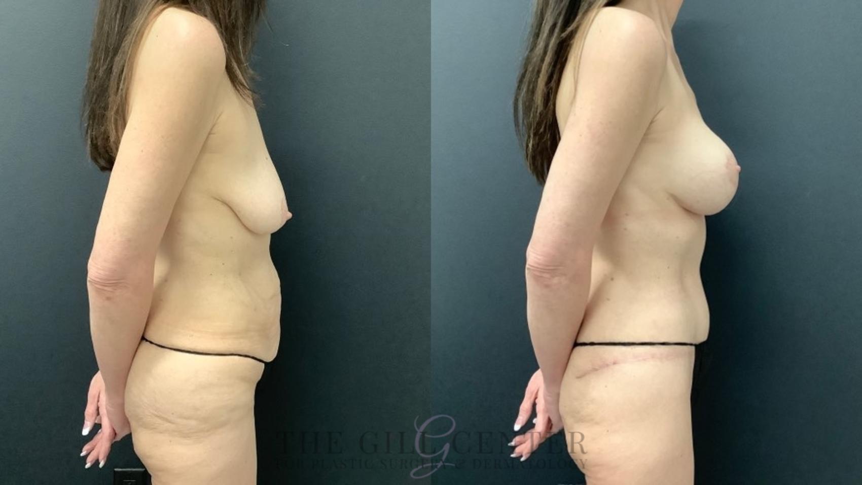 Mommy Makeover Case 550 Before & After Right Side | The Woodlands, TX | The Gill Center for Plastic Surgery and Dermatology