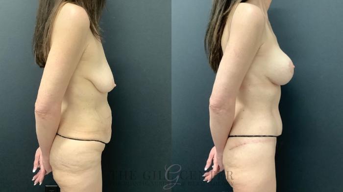 Mommy Makeover Case 550 Before & After Right Side | The Woodlands, TX | The Gill Center for Plastic Surgery and Dermatology