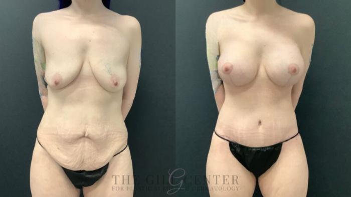 Mommy Makeover Case 571 Before & After Front | The Woodlands, TX | The Gill Center for Plastic Surgery and Dermatology