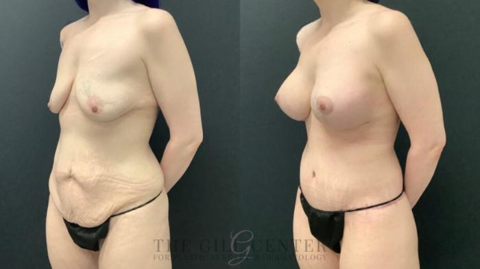 Mommy Makeover Case 571 Before & After Left Oblique | The Woodlands, TX | The Gill Center for Plastic Surgery and Dermatology
