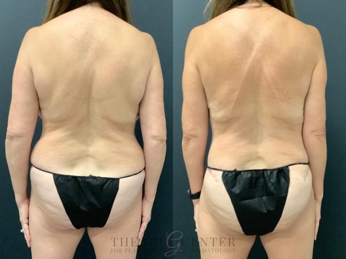 Mommy Makeover Case 576 Before & After Back | The Woodlands, TX | The Gill Center for Plastic Surgery and Dermatology