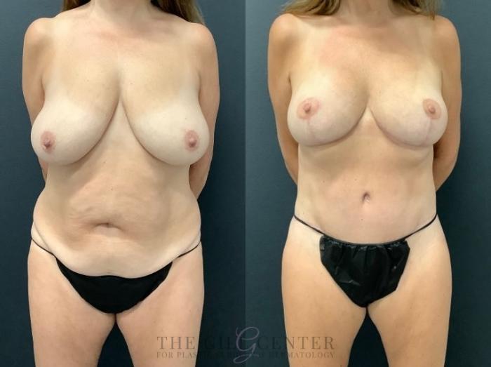 Mommy Makeover Case 576 Before & After Front | The Woodlands, TX | The Gill Center for Plastic Surgery and Dermatology