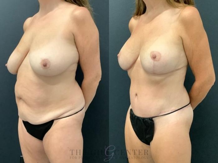 Mommy Makeover Case 576 Before & After Left Oblique | The Woodlands, TX | The Gill Center for Plastic Surgery and Dermatology