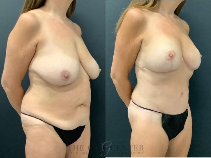 Mommy Makeover Case 576 Before & After Right Oblique | The Woodlands, TX | The Gill Center for Plastic Surgery and Dermatology