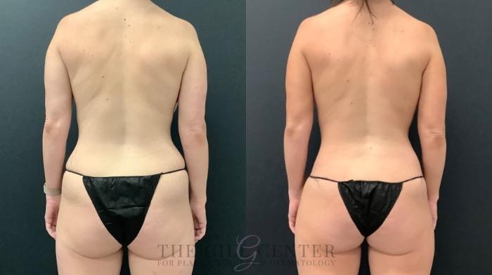 Mommy Makeover Case 579 Before & After Back | The Woodlands, TX | The Gill Center for Plastic Surgery and Dermatology