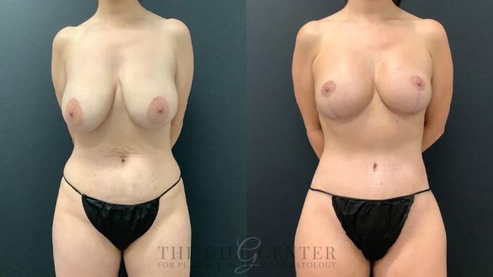 Mommy Makeover Case 579 Before & After Front | The Woodlands, TX | The Gill Center for Plastic Surgery and Dermatology
