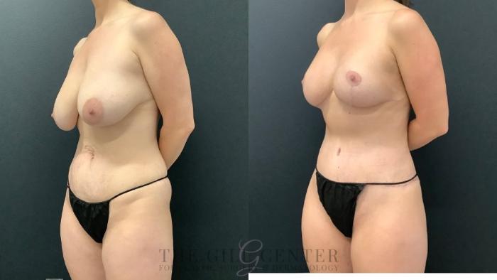 Mommy Makeover Case 579 Before & After Left Oblique | The Woodlands, TX | The Gill Center for Plastic Surgery and Dermatology