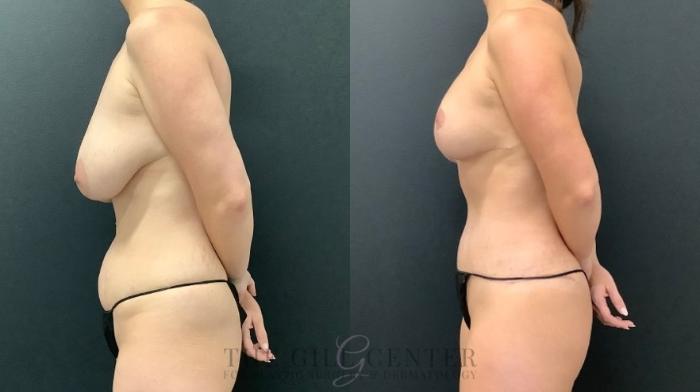 Mommy Makeover Case 579 Before & After Left Side | The Woodlands, TX | The Gill Center for Plastic Surgery and Dermatology
