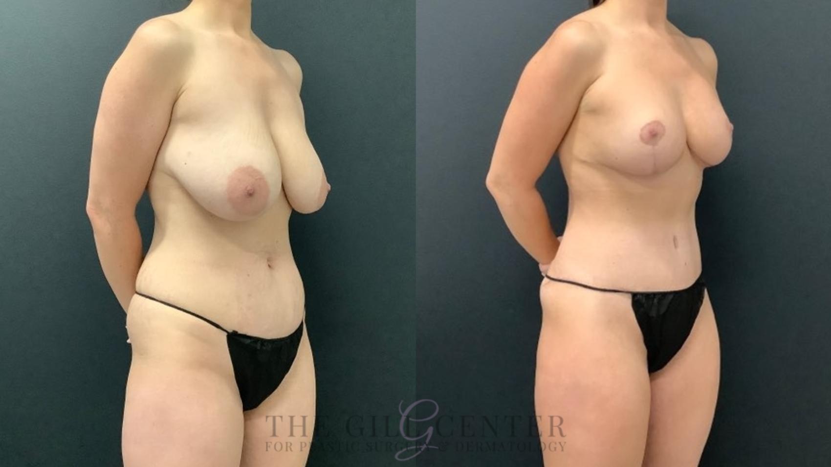 Mommy Makeover Case 579 Before & After Right Oblique | The Woodlands, TX | The Gill Center for Plastic Surgery and Dermatology