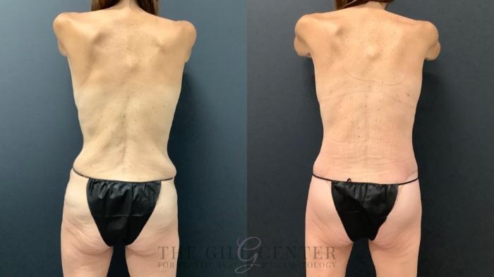 Mommy Makeover Case 583 Before & After Back | The Woodlands, TX | The Gill Center for Plastic Surgery and Dermatology