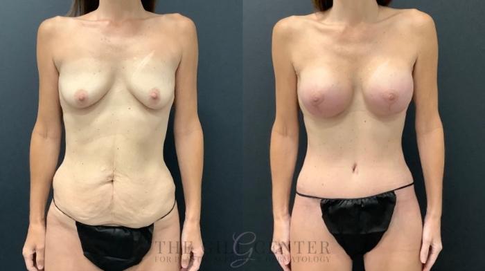 Mommy Makeover Case 583 Before & After Front | The Woodlands, TX | The Gill Center for Plastic Surgery and Dermatology