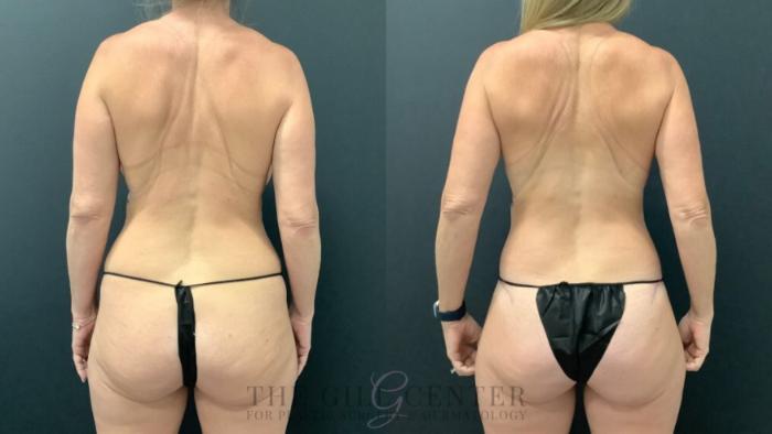 Breast Revisions Case 584 Before & After Back | The Woodlands, TX | The Gill Center for Plastic Surgery and Dermatology