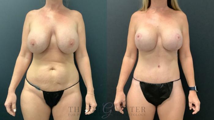 Breast Revisions Case 584 Before & After Front | The Woodlands, TX | The Gill Center for Plastic Surgery and Dermatology