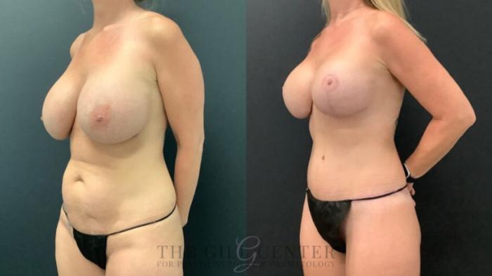 Breast Revisions Case 584 Before & After Left Oblique | The Woodlands, TX | The Gill Center for Plastic Surgery and Dermatology